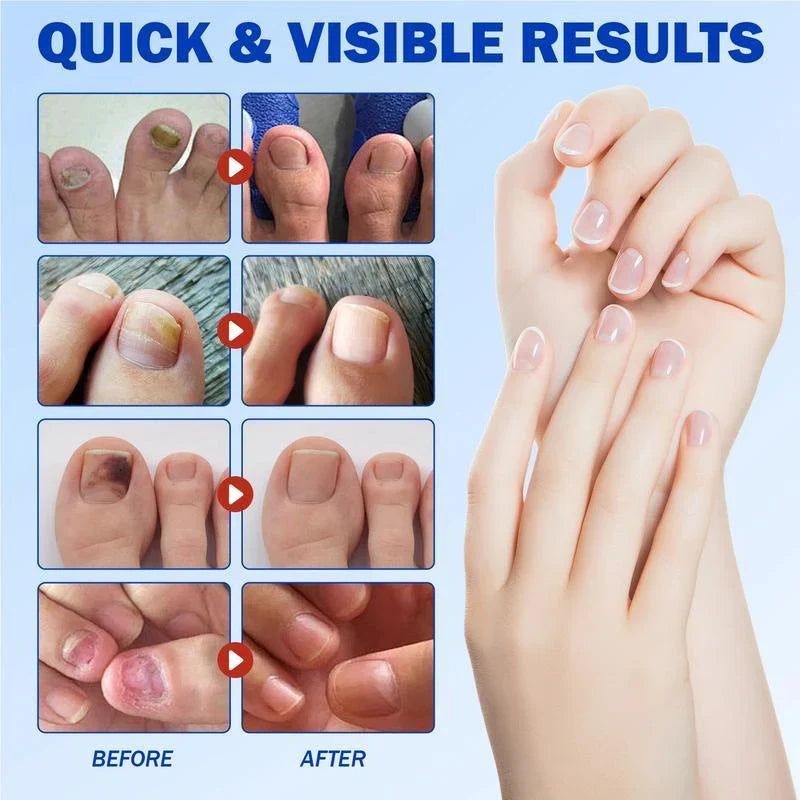 Elevora Fungal Nail Repair Patches