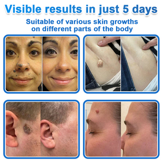 🎁2-in-1 Microneedle & Hydrocolloid Patch | Raised Moles,Acne, Flat Warts & Skin Tags Remover | Improves Wrinkles, Scars & Blemishes | Invisible Pimple Patches for Face & Body