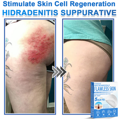 🎁2-in-1 Microneedle & Hydrocolloid Patch | Raised Moles,Acne, Flat Warts & Skin Tags Remover | Improves Wrinkles, Scars & Blemishes | Invisible Pimple Patches for Face & Body