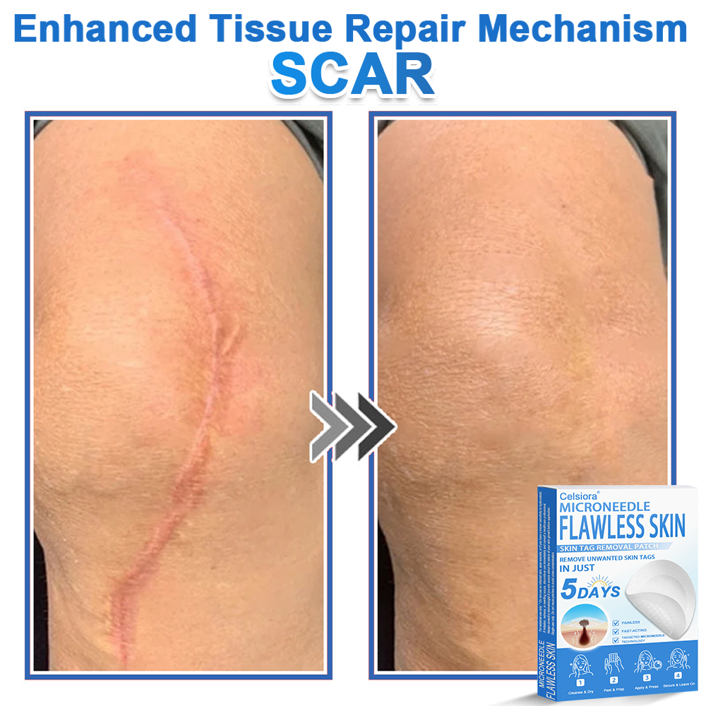 🎁2-in-1 Microneedle & Hydrocolloid Patch | Raised Moles,Acne, Flat Warts & Skin Tags Remover | Improves Wrinkles, Scars & Blemishes | Invisible Pimple Patches for Face & Body