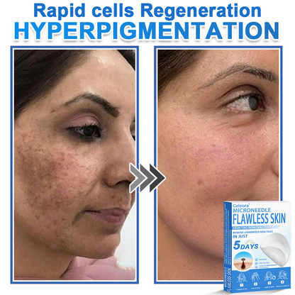 🎁2-in-1 Microneedle & Hydrocolloid Patch | Raised Moles,Acne, Flat Warts & Skin Tags Remover | Improves Wrinkles, Scars & Blemishes | Invisible Pimple Patches for Face & Body