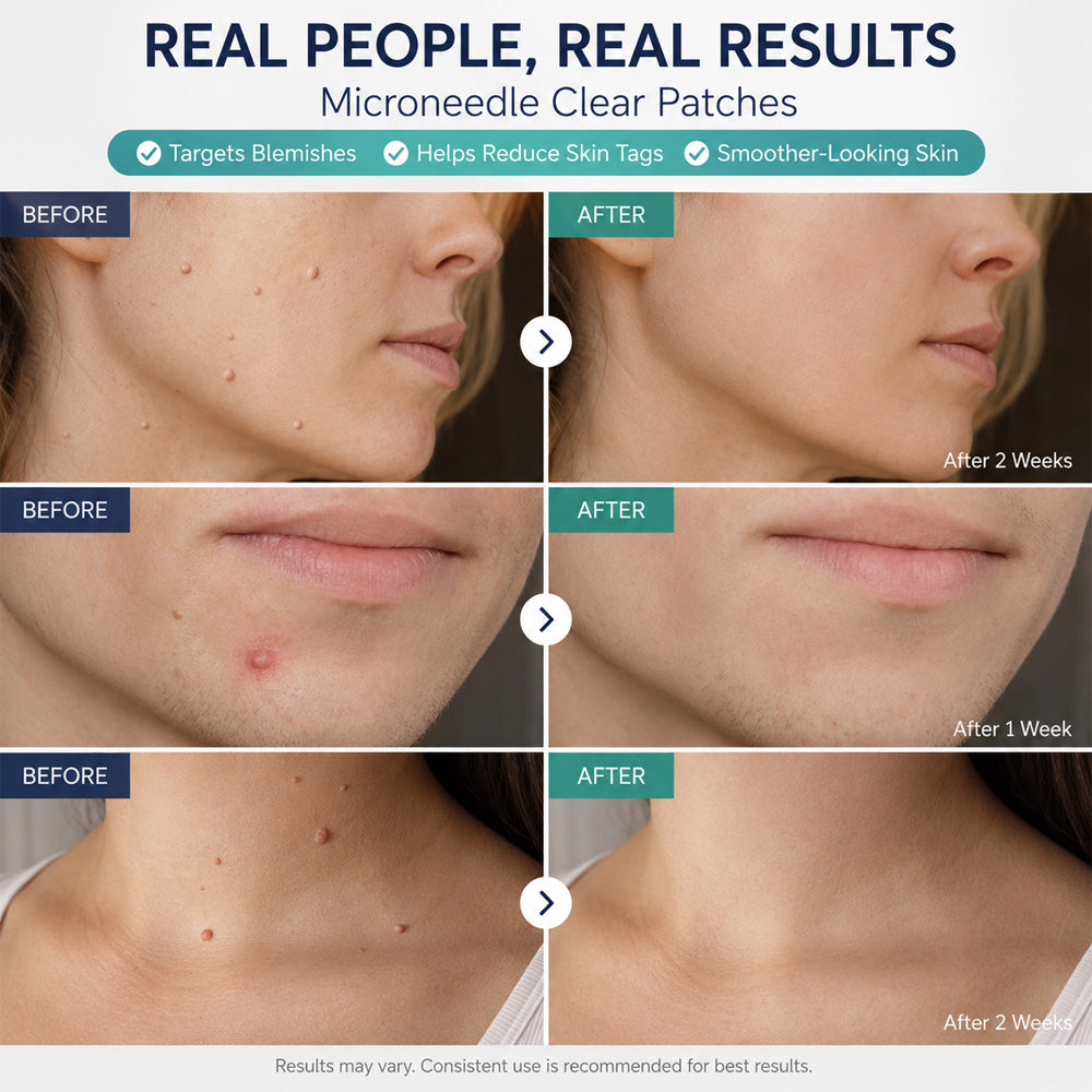 Effective MicroNeedle BotanicSkinTag Removal Patch