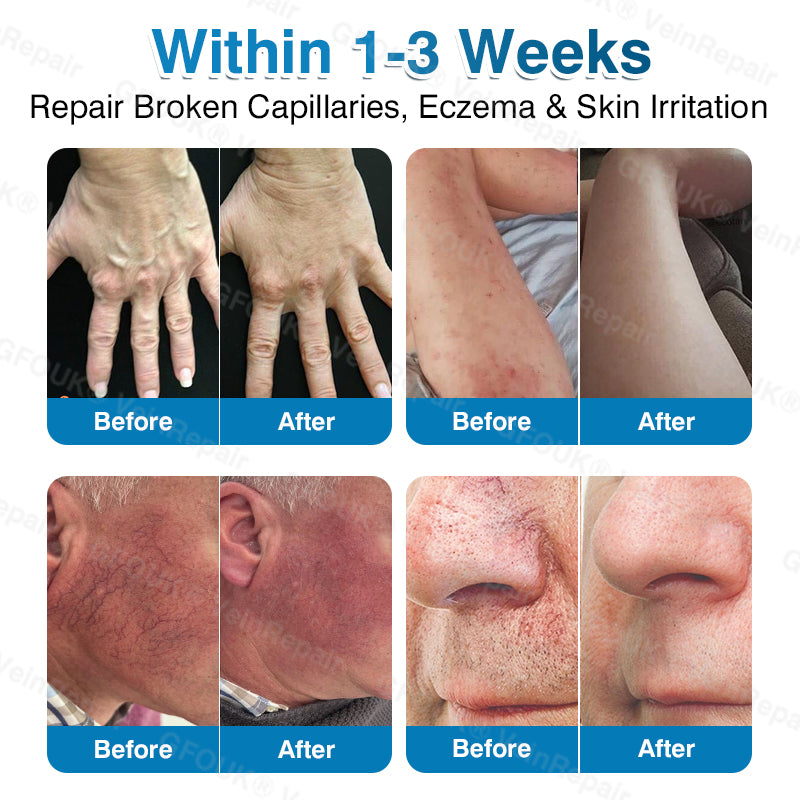 🇨🇦🏆✅️🏃ROVINAO® VeinRepair Microneedle Patch Roll⚡Instant Relief, Long-Term Results