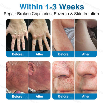 VeinRepair Microneedle Patch Roll⚡Instant Relief, Long-Term Results