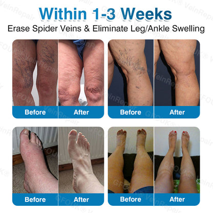 🇨🇦🏆✅️🏃ROVINAO® VeinRepair Microneedle Patch Roll⚡Instant Relief, Long-Term Results