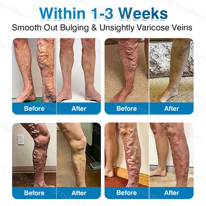 🇨🇦🏆✅️🏃ROVINAO® VeinRepair Microneedle Patch Roll⚡Instant Relief, Long-Term Results