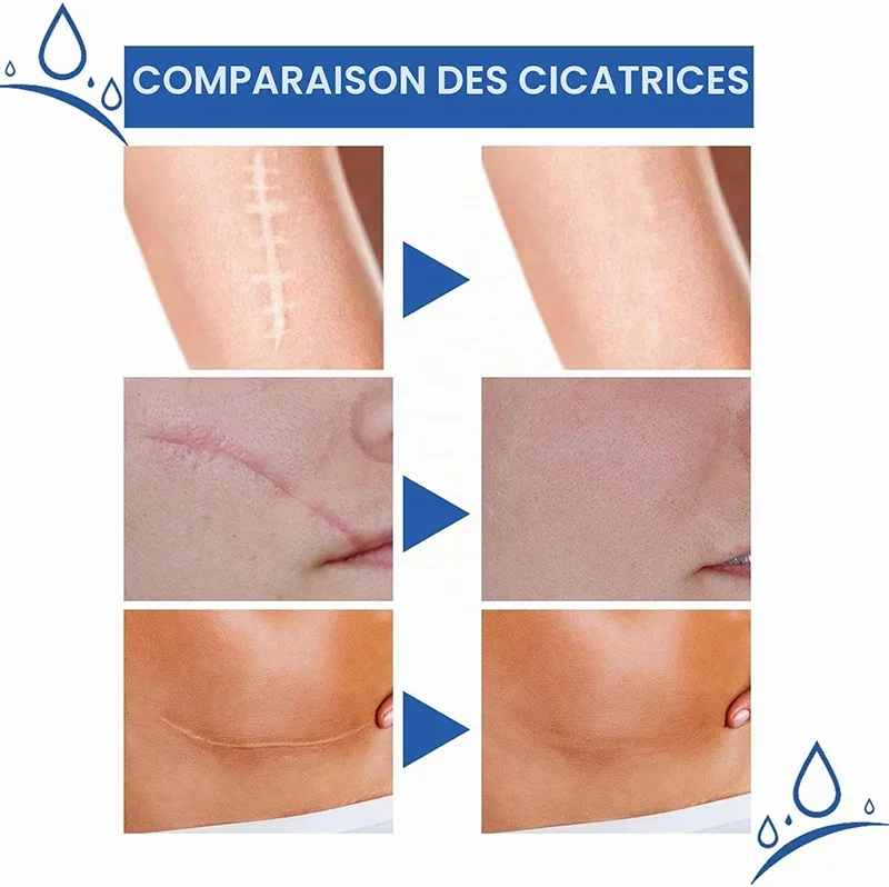 Fempick Scar Smooth – Great Care Cream for All Types of Skin Marks 🧴