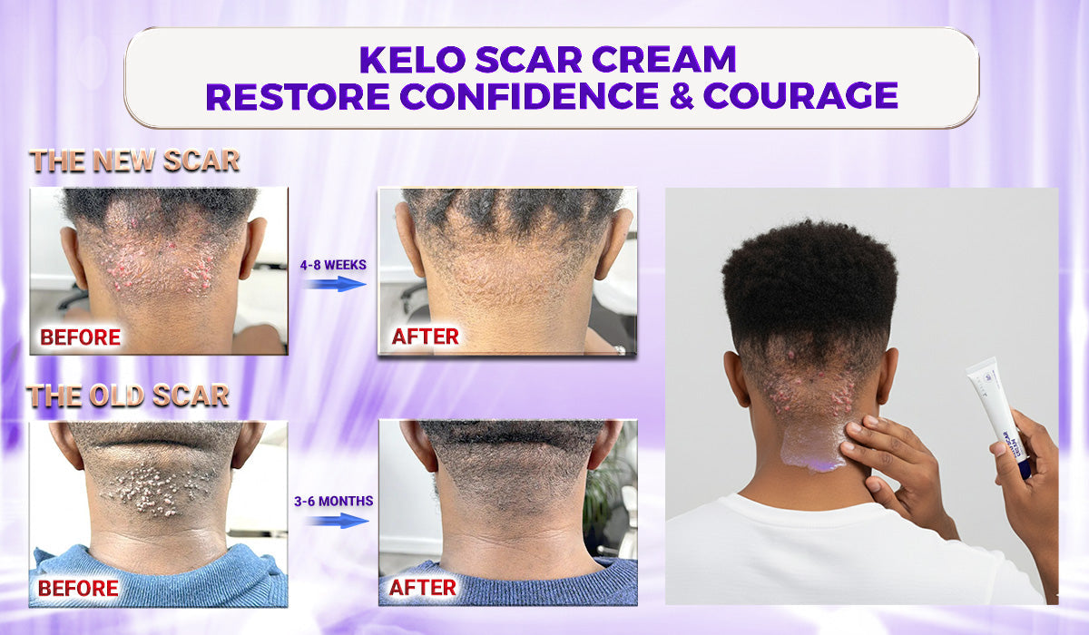 Abera Kelo Scar Care Cream - Top Seller