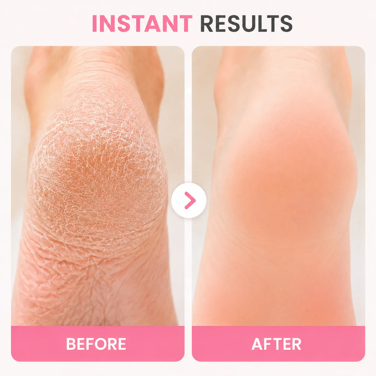 Valanea SilkSmooth Pro™ Electric Foot Callus Remover