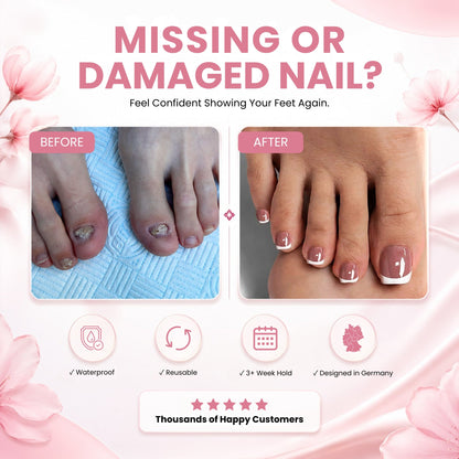 GLUI For Missing & Damaged Toenails