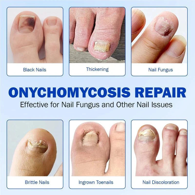 Elevora Fungal Nail Repair Patches