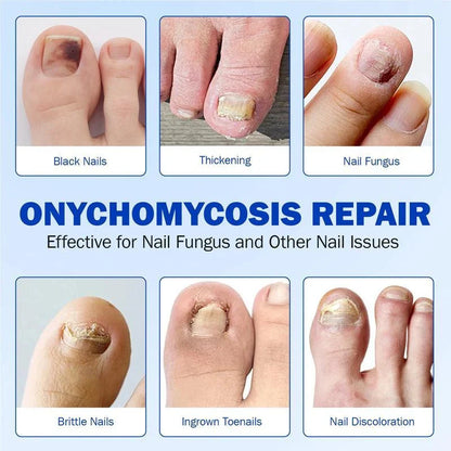 Elevora Fungal Nail Repair Patches