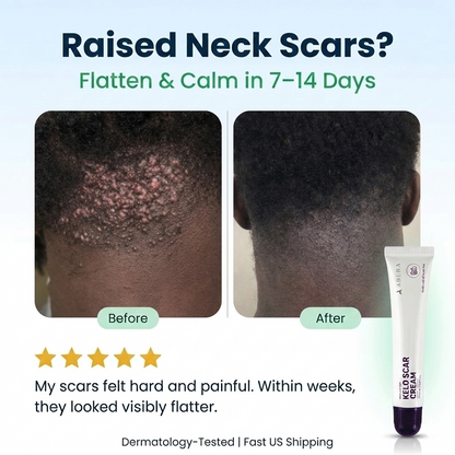 Abera Kelo Scar Care Cream - Top Seller